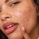 Гель-крем для лікування плям після висипів Dermalogica Clear Start Post Breakout Fix, 15 мл 666151112643 фото 3